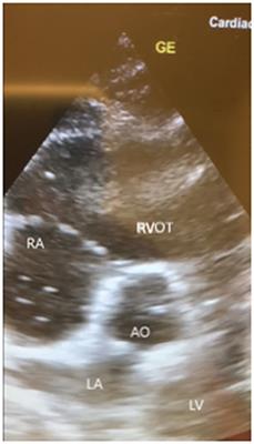 Fat embolism syndrome in a patient that sustained a femoral neck fracture: A case report